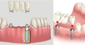 Tratamento dentário e colocação de próteses
