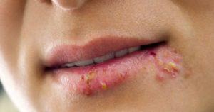 Dicas para evitar o aparecimento da herpes labial