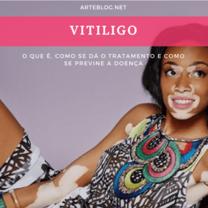 O que é vitiligo, como tratar e quais os sintomas