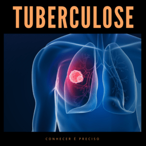Tuberculose: conheça e saiba como tratá-la
